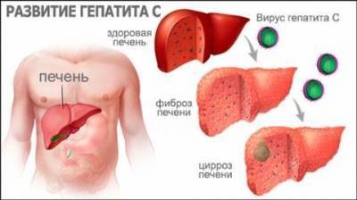 Современные препараты для лечения гепатита С на основе Софосбувир (Sofosbuvir) - lifehelper.one