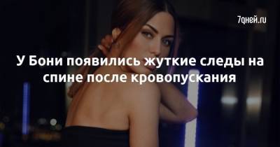 Викторий Боня - У Бони появились жуткие следы на спине после кровопускания - 7days.ru