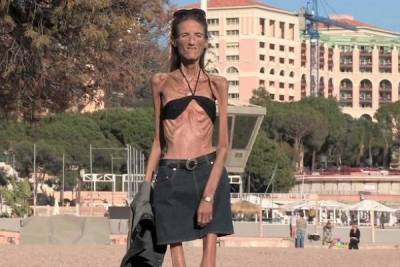Жизнь и смерть самой худой женщины планеты nbsp - woman.rambler.ru - Сша