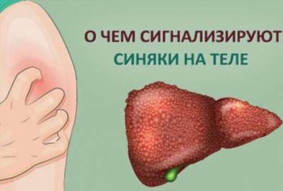 Почему появляются синяки на теле без причины - lublusebya.ru