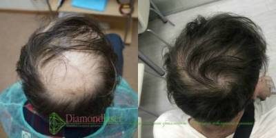 Важные особенности пересадки волос - lifehelper.one - Киев