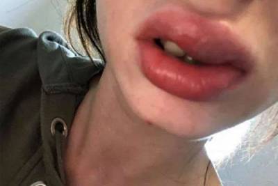 Неумелый косметолог изуродовала губы девушке и занесла опасную болезнь - lublusebya.ru - Шотландия