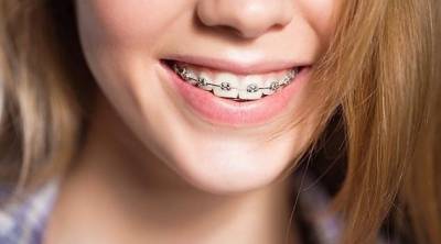 Выровнять зубы брекетами: как сделать это красиво - womo.ua - Киев
