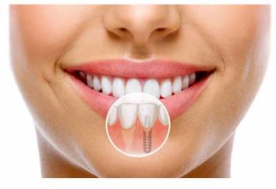 Что нужно знать о зубных имплантах? - epochtimes.com.ua - Киев