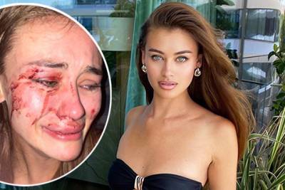 Украинская модель Дарья Кирилюк рассказала, что ее жестоко избили в Турции - spletnik.ru - Украина - Турция