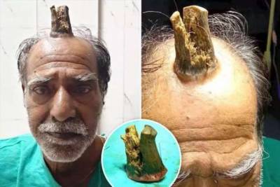 В Индии врачи удалили мужчине 10-сантиметровый рог - chert-poberi.ru - Индия