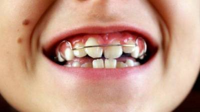 Особенности прикуса у детей: как исправить прикус ортодонтическими пластинами отвечает детский ортодонт стоматологии «Улыбнись» - lifehelper.one