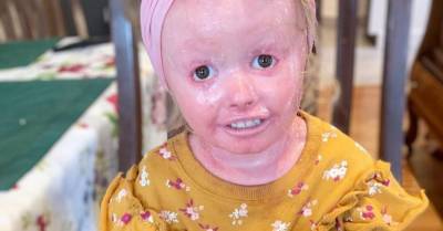 Девочка с редким синдромом и ярко-розовой кожей стала звездой Instagram - wmj.ru