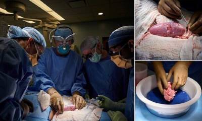 Хирурги успешно пересадили человеку почки свиньи - porosenka.net - Сша - Нью-Йорк - Нью-Йорк