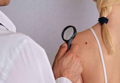 Симптомы рака кожи (меланомы): 5 изменений, которые нельзя игнорировать - lublusebya.ru