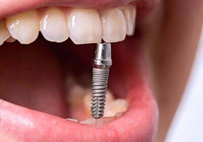 Имплантация зубов: чем отличается эта процедура под ключ, что входит в перечень этих услуг, чем отличаются различные методики протезирования - ladyspages.com