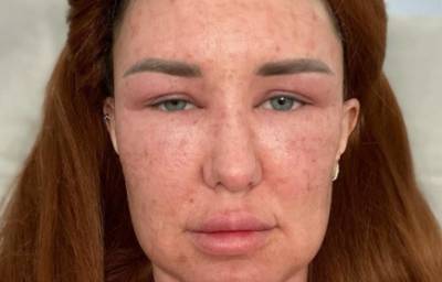 «Не могу открыть глаза»: москвичка показала жуткий результат после популярной процедуры красоты nbsp - woman.rambler.ru