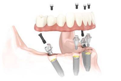 Имплантация зубов методом «All-on-four» (Все на четырех) - lifehelper.one - Россия
