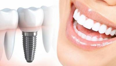 Врач-стоматолог подробно рассказала про дентальные имплантаты - fokus-vnimaniya.com