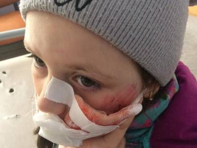 9-летняя девочка из Нижнего Одеса после нападения собаки направлена в Ухтинскую горбольницу - mur.tv