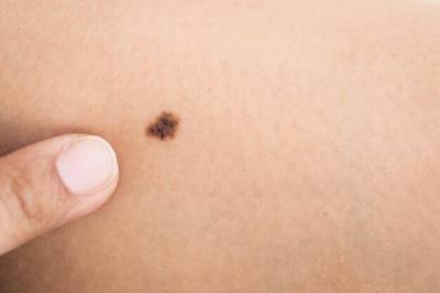 7 признаков рака кожи, на которые мало кто обращает внимания - porosenka.net