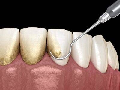 Причины возникновения зубного камня - polsov.com