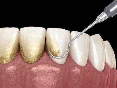 Причины возникновения зубного камня - lifehelper.one