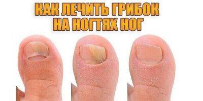 ​Как лечить грибок на ногтях ног - polsov.com