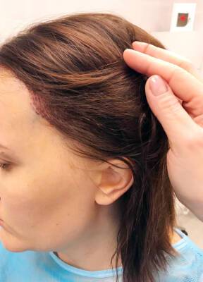 Пересадка волос в Киеве и области: какой метод считается наиболее передовым, кому он показан, куда пересаживают волосы помимо кожи головы, как проходит операция - ladyspages.com - Киев