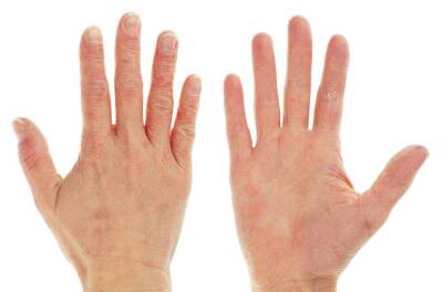 Как лечить трещины на пальцах рук? - lifehelper.one