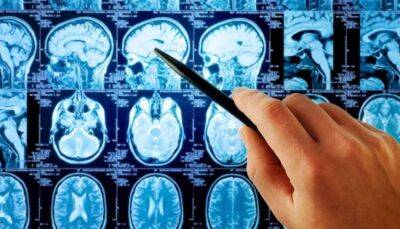 На ранних стадиях развития опухоли головного мозга шанс выжить достигает 100% - fokus-vnimaniya.com - Россия