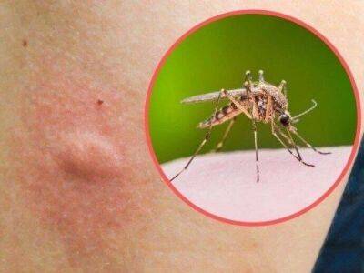 ​Как легко снять зуд от укусов комаров - lifehelper.one