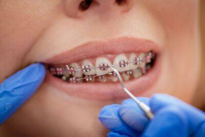 Что нужно знать перед установкой ортодонтических брекетов? - ladyspages.com