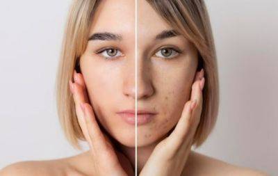 Прищі та місячні: експерт розповіла, як врятувати шкіру обличчя і виглядати приголомшливо - hochu.ua