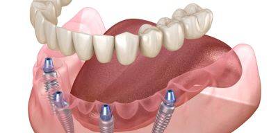 Имплантация зубов all on 4: показания, особенности и преимущества - jlady.ru