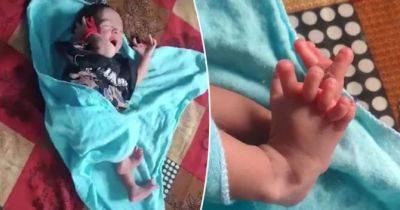 В Індії народилася дитина з 26 пальцями рук і ніг: фото - womo.ua - Индия